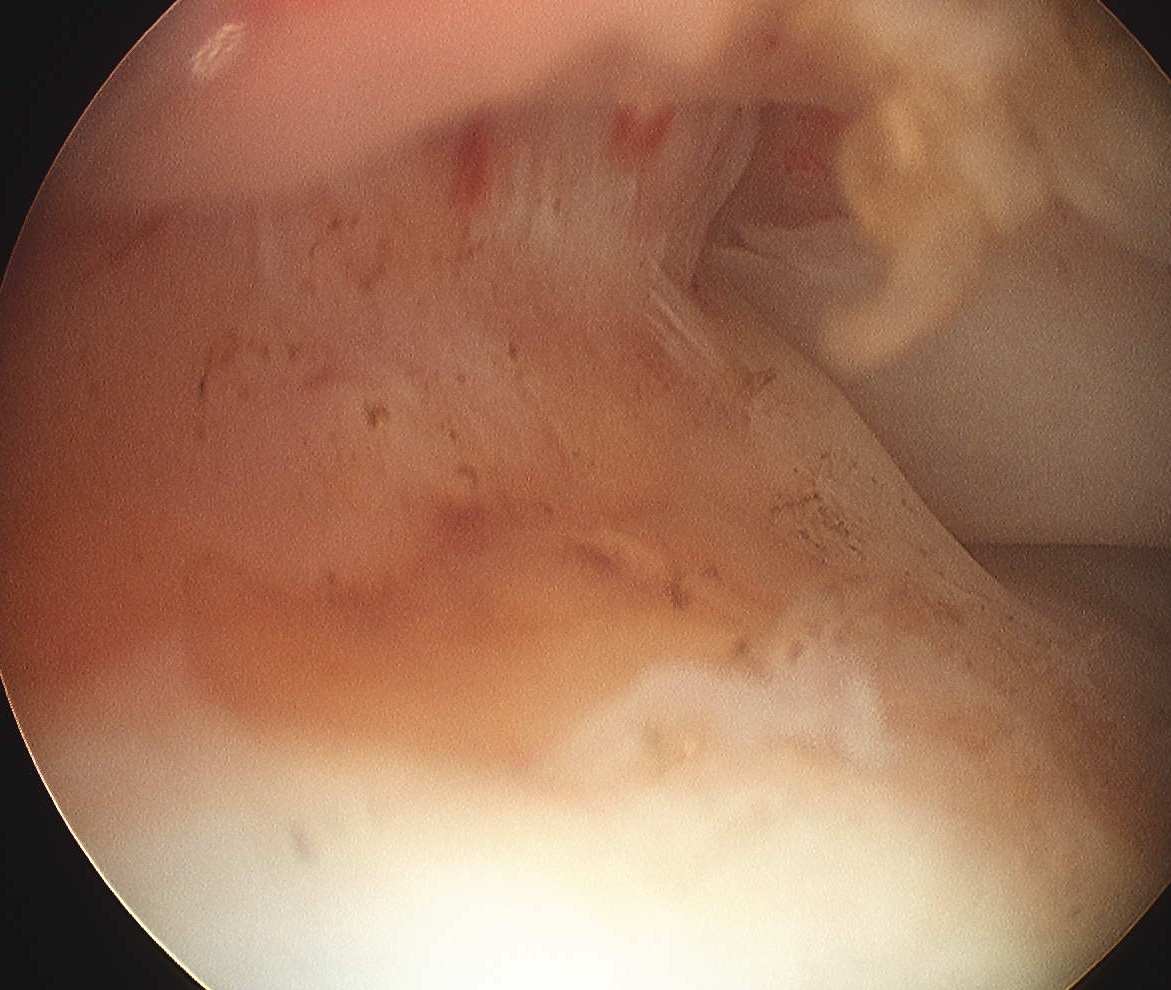 Articular sided tear